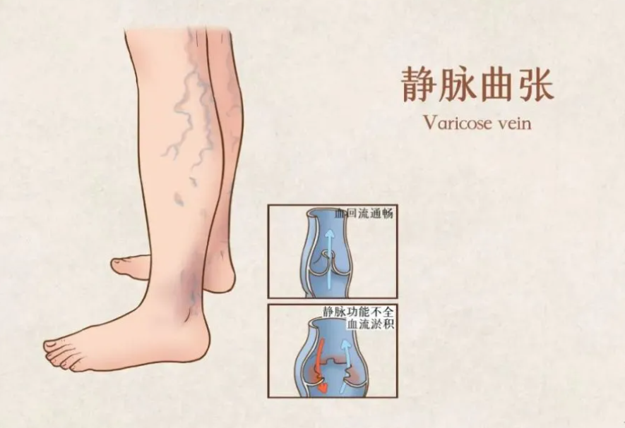 靜脈曲張不用開刀，介入治療也能輕松處理