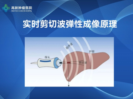 【高新喜報】我院開展肝臟實時剪切波彈性成像檢查技術(shù)，肝纖維化、肝硬化可以無創(chuàng)診斷啦！