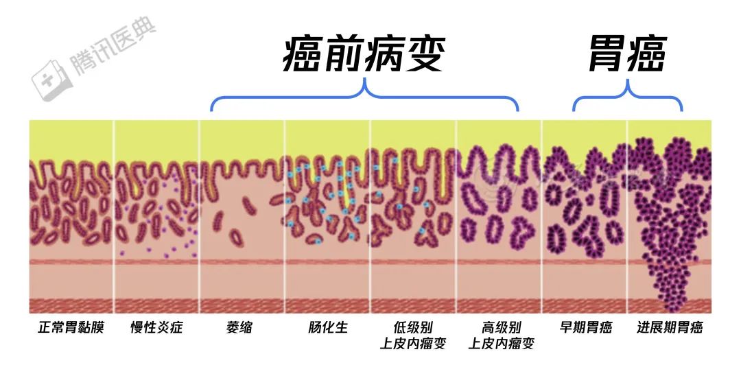 胃癌來臨前，會(huì)經(jīng)歷這個(gè)階段！千萬別不當(dāng)回事